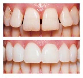 veneersjpg
